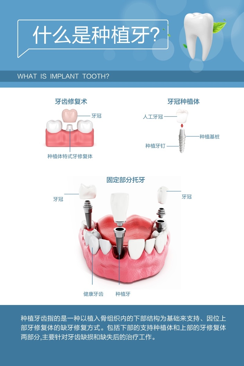 牙科装饰画什么是种植牙