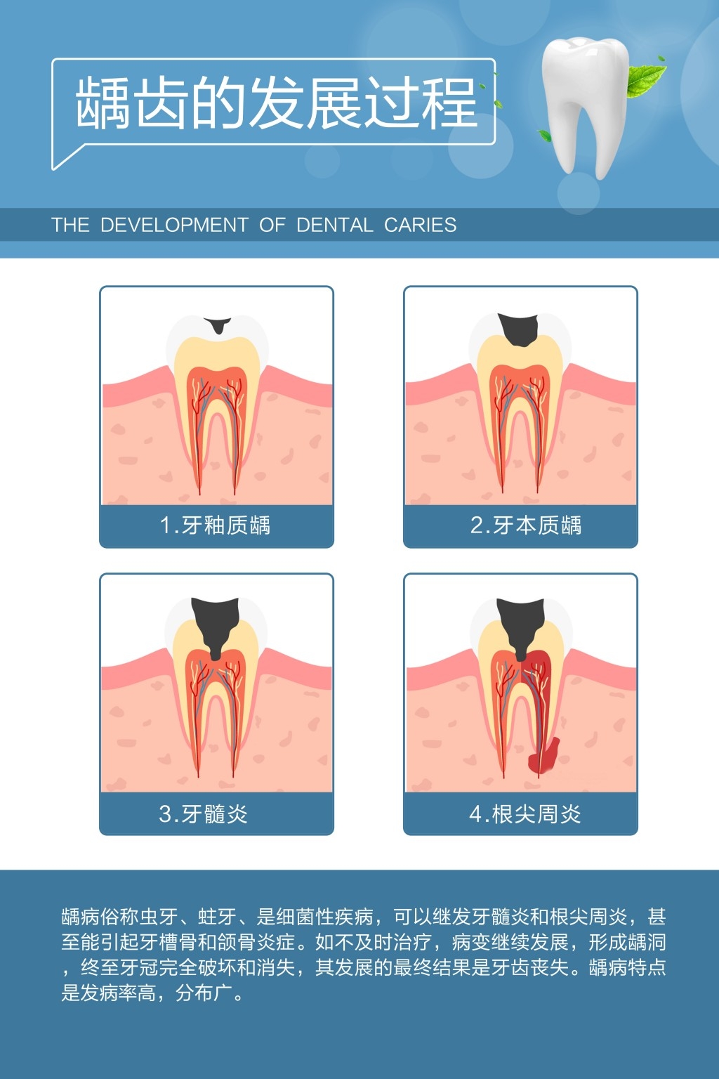 口腔诊所挂图龋齿的发展过程10